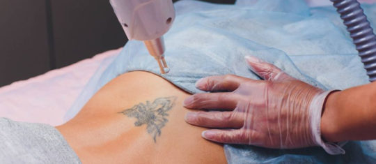 enlever le tatouage